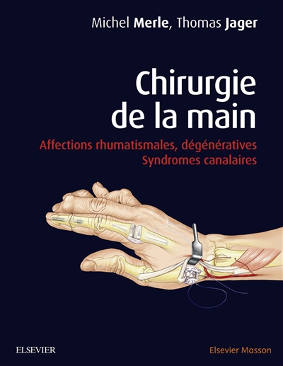 Chirurgie de la main : affections rhumatismales, dégénératives : syndromes canalaires
