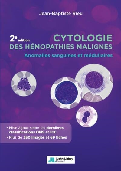 Cytologie des hémopathies malignes : anomalies sanguines et médullaires